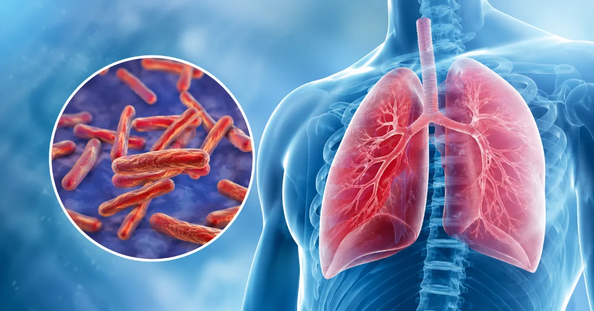 Tuberculosis